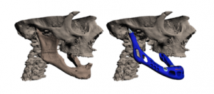 lower-jaw-3d-printed3